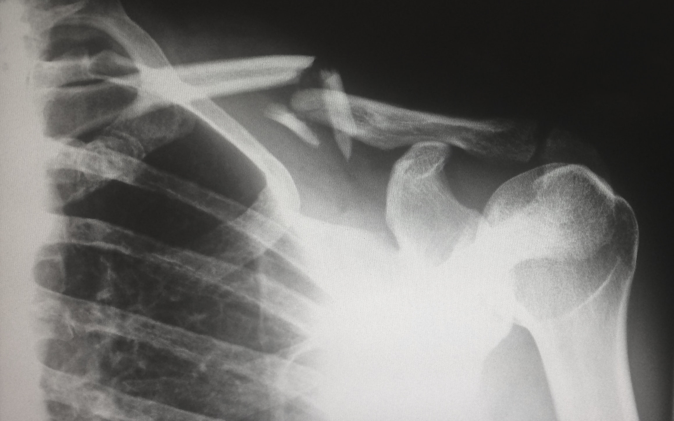 Broken Bone X-Ray Image at 2100 Webster Medical Office Building in San Francisco's Pacific Heights neighborhood